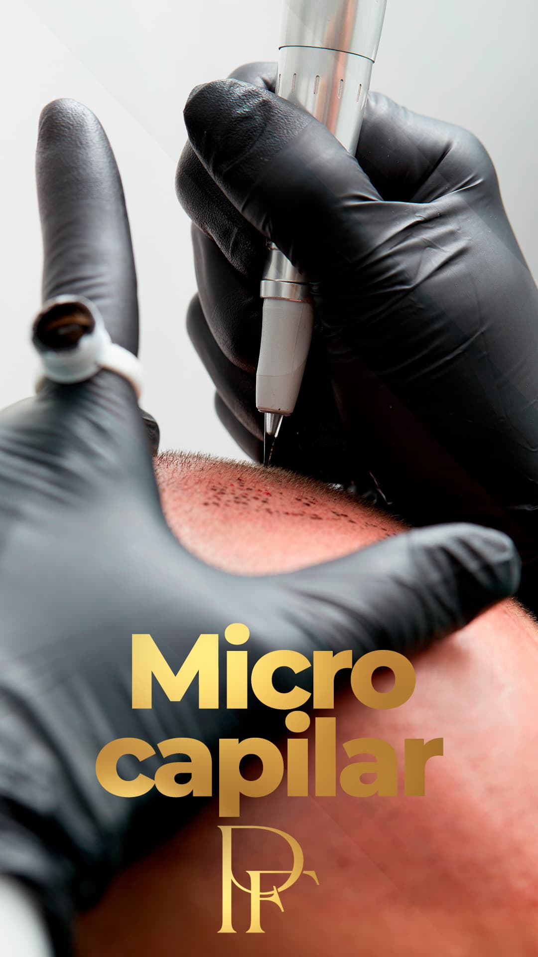 Micropigmentação Capilar